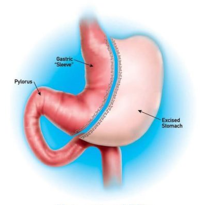 Laparoscopic Surgeries