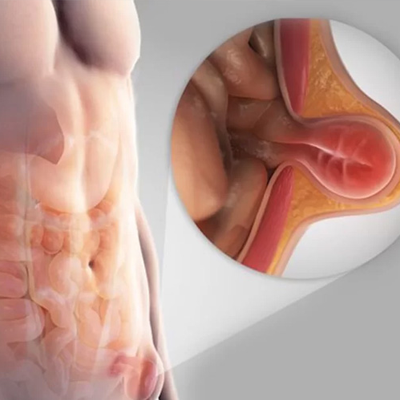 Hernia & Hydrocele Surgery