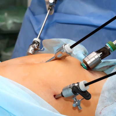 Laparoscopic Surgeries