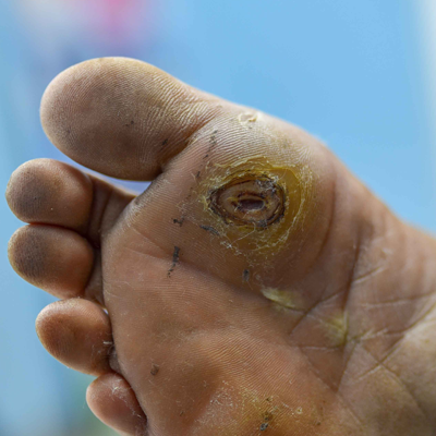 Diabetic Wound Care