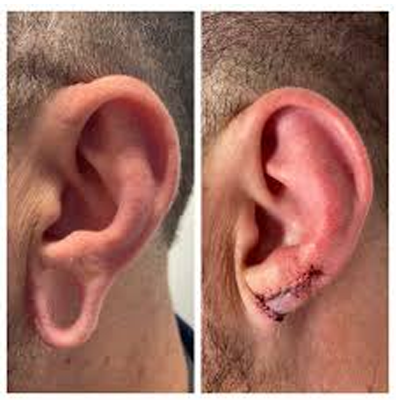 Earlobe Repair