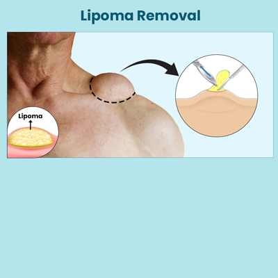 Lipoma Removal
