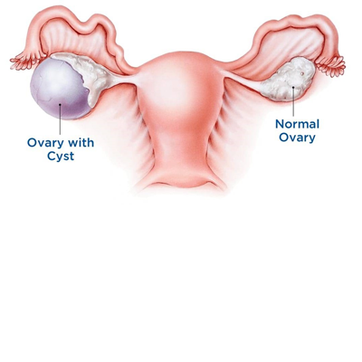 Ovarian Cyst Surgery
