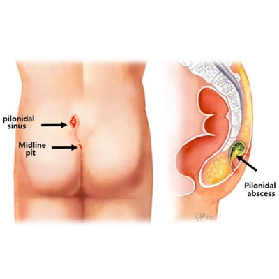 Perianal Abscess & Pilonidal Sinus