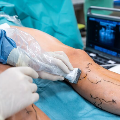 Varicose Vein Treatment